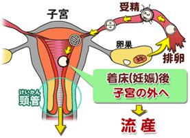 流産・切迫流産