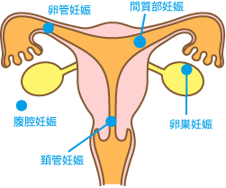 妊娠 子宮 症状 外