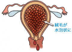 胞状奇胎