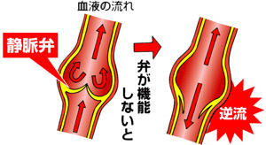 静脈瘤