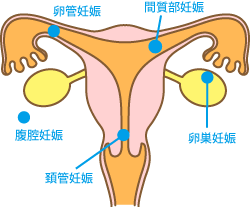 子宮外妊娠 妊娠初期 妊娠中のトラブル プレママ 妊娠 出産応援